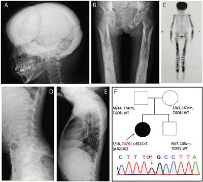 Improvement of Bone Health and Initiation of Puberty Development in Camurati-Engelmann Disease With Glucocorticoid and Losartan Treatment: A Case Report and Review of Literature